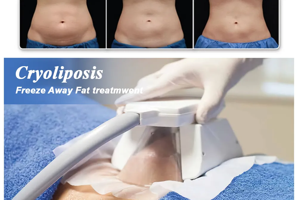 Cryotherapy treatment at A.I. Skin Revolution BGC