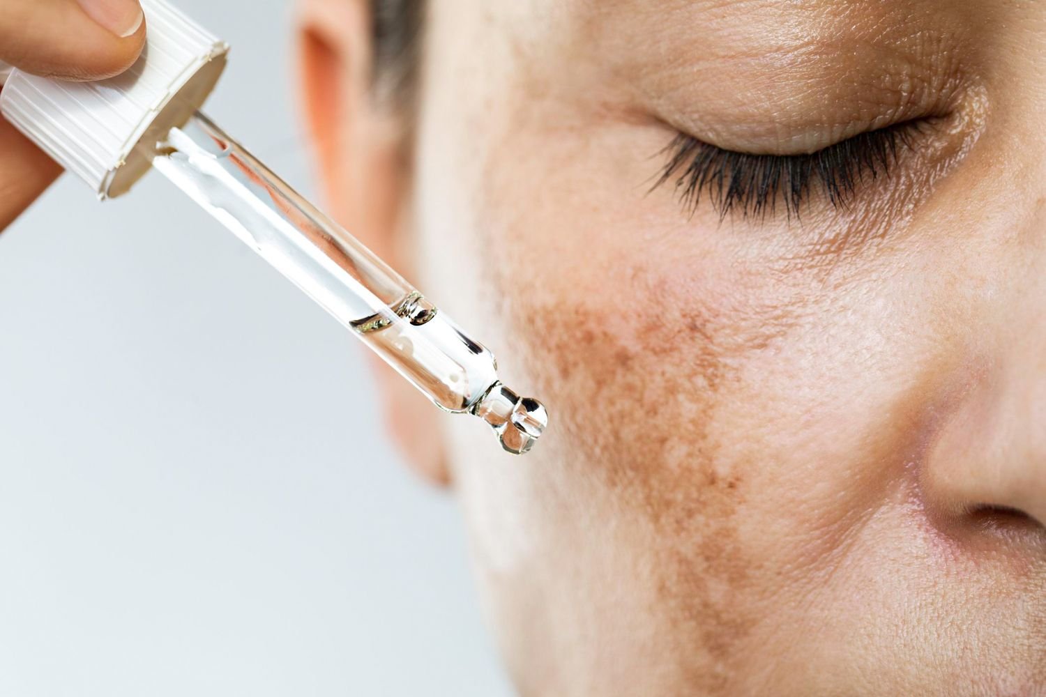 Melasma pigmentation treatment